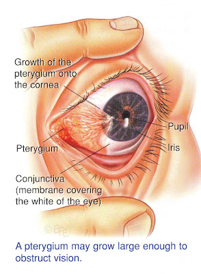 Ventral Pterygium Nail