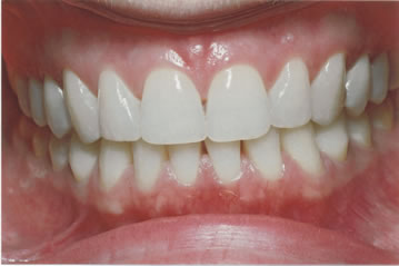 What Do Healthy Gums Look Like