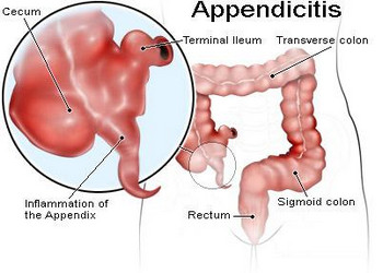 Where Are Your Appendix Located Diagram