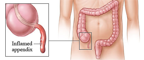 Where Are Your Appendix Located In The Human Body