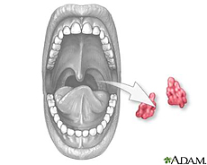 Where Are Your Tonsils Located In Your Throat