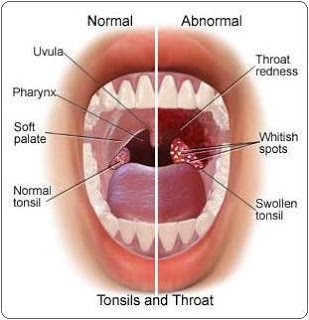 Where Are Your Tonsils Located On Your Neck