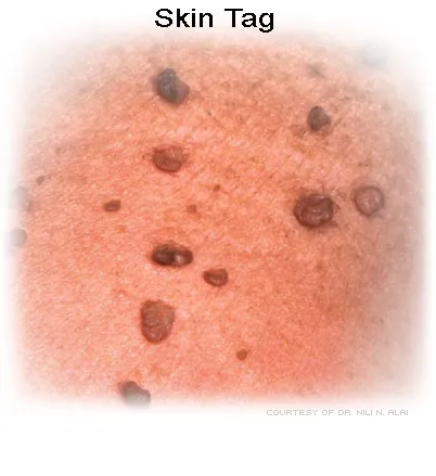 White Skin Tags On Face